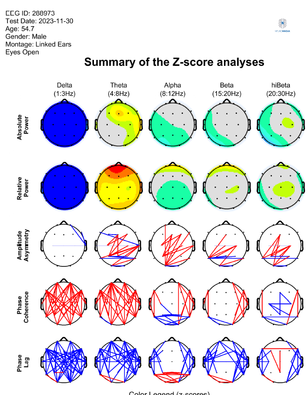 Resumen de análisis QEEG con mapas de Delta, Theta, Alpha, Beta y hiBeta, y gráficas de coherencia y desfase.