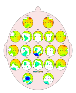 Mapa cerebral QEEG con múltiples topografías por regiones del cuero cabelludo, en tonos verde, amarillo, naranja y azul.