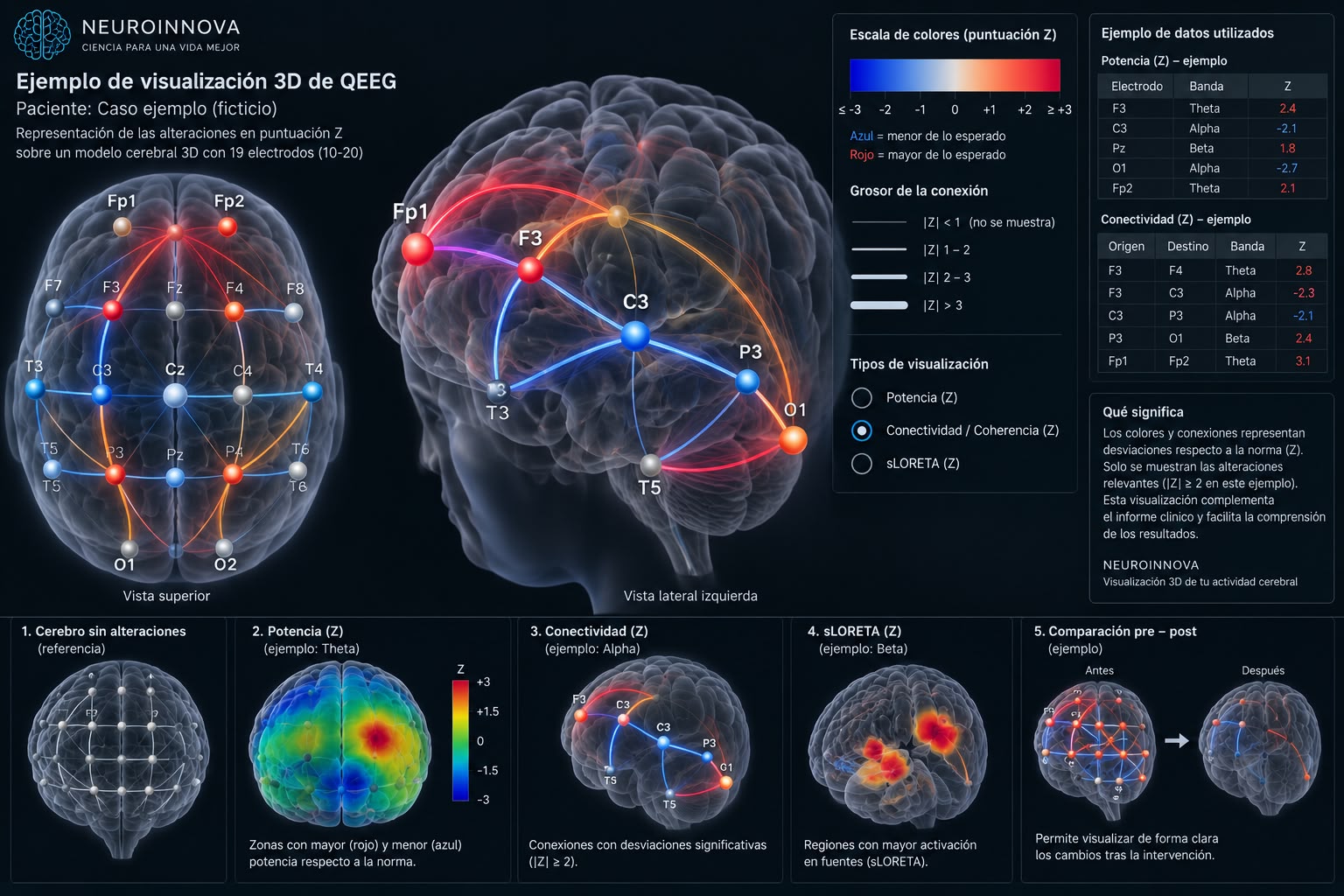 Visualización 3D de QEEG con mapas cerebrales, electrodos y conexiones codificadas por colores según puntuaciones Z